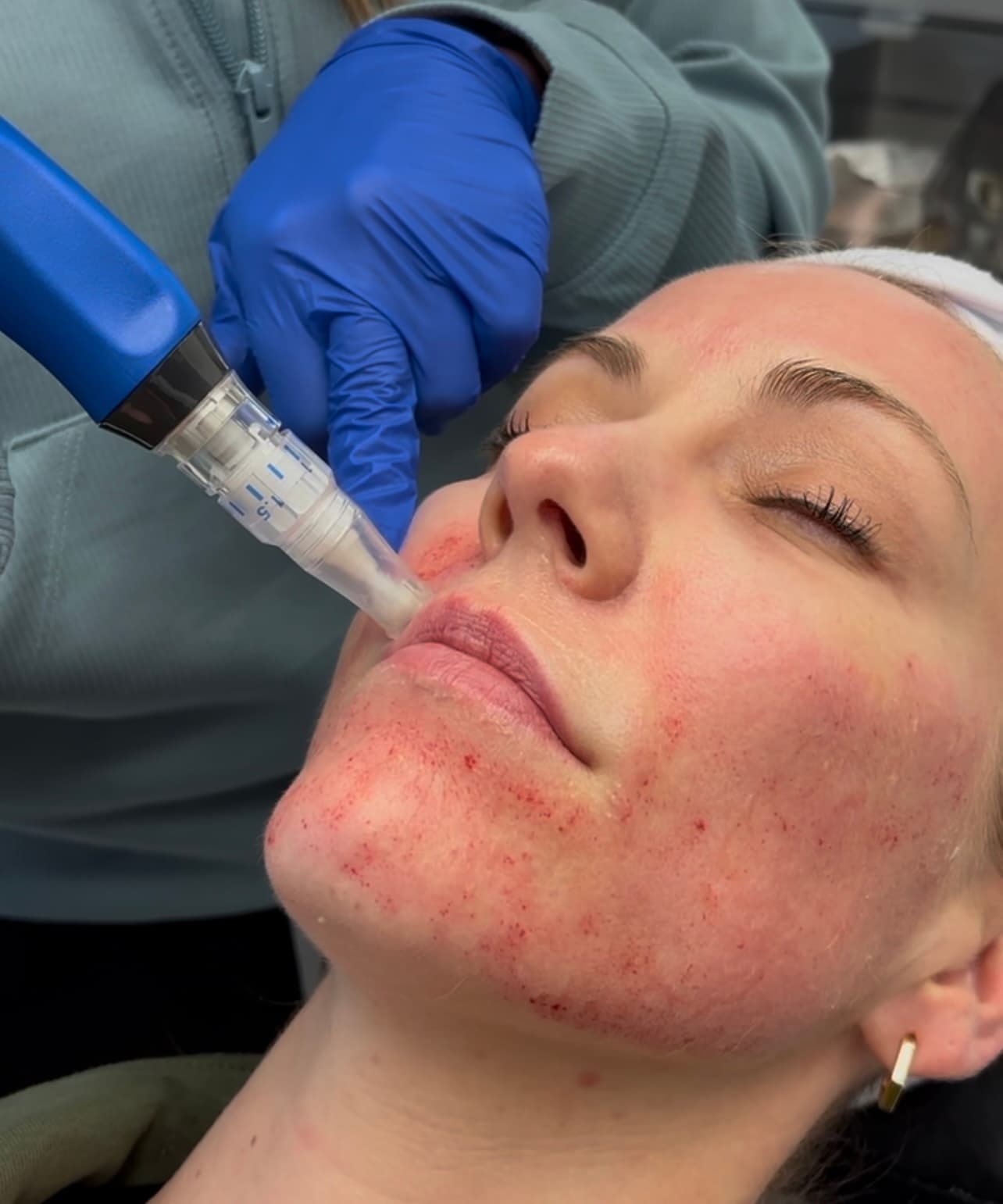 Microneedlling skin treatment