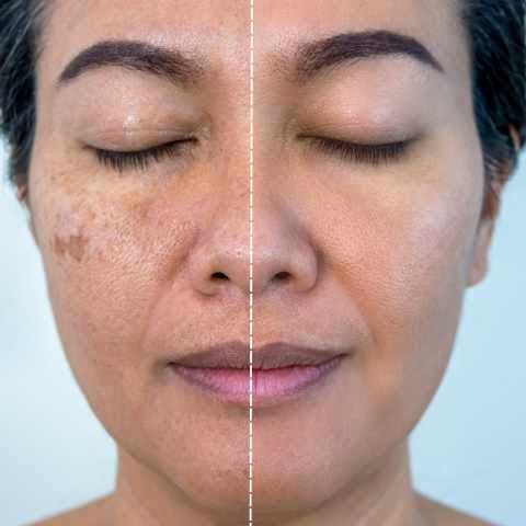 Pigmentation skin treatment